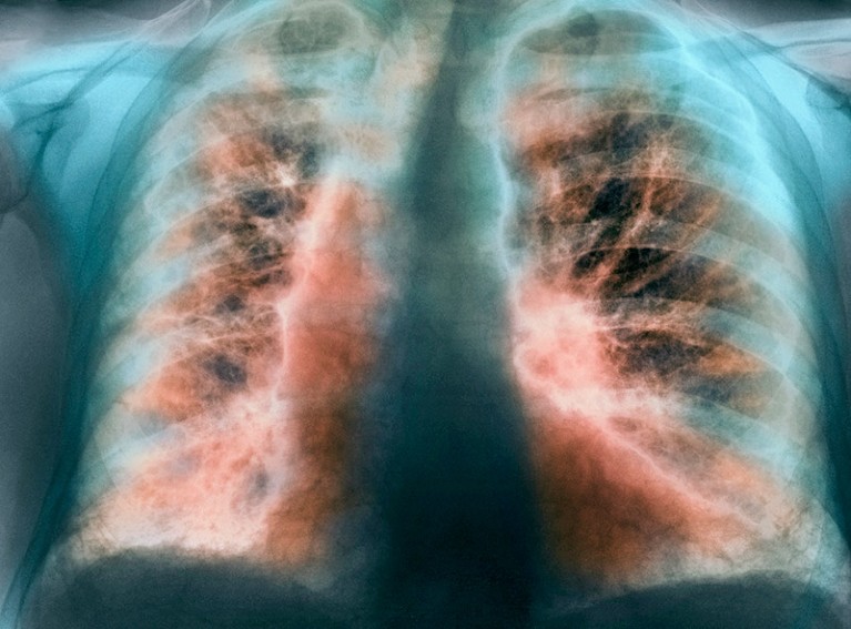 Coloured X-ray of the chest of an 82-year-old man with fibrosing alveolitis of the lungs