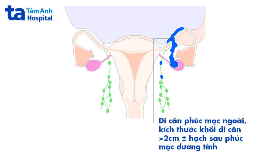 ung thư buồng trứng giai đoạn 3 ung thư buồng trứng giai đoạn 3 di căn